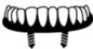 Overdentures